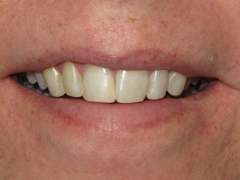 Internal Bleaching and Bonding after 324953