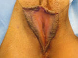 Labia Reduction Surgery before 133969