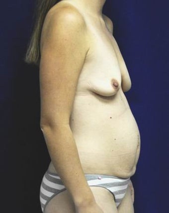 Mommy Makeover 419403