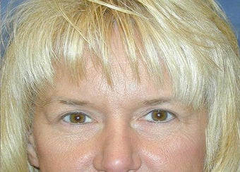 Blepharoplasty after 142232
