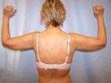 Arm Lift Surgery (Brachioplasty) after 151088
