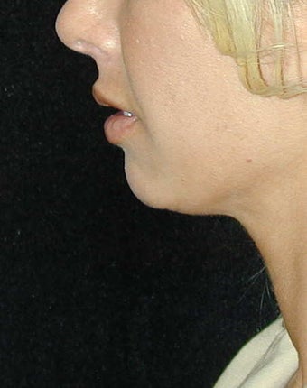 Chin Surgery before 101318