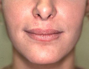 Lip Augmentation with Liquid Injectable Silicone before 157589