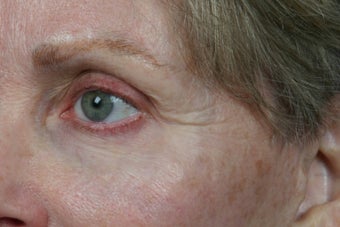 Botox before 309232