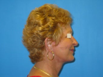 Facelift after 147388