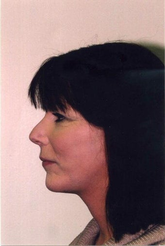 Neck Lift after 215150