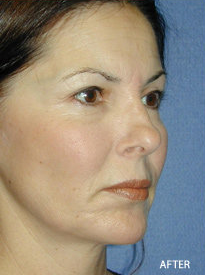 Cheek Implant Surgery after 328076