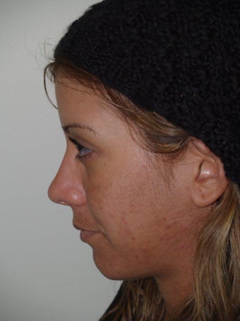 Revision Rhinoplasty after 481039