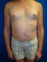 Transgender Surgery- Breast Implants before 131869