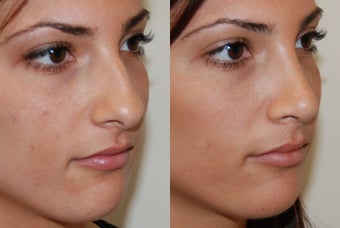 Rhinoplasty Surgery before 206915