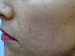 Fractional laser used to treat acne scars 460041
