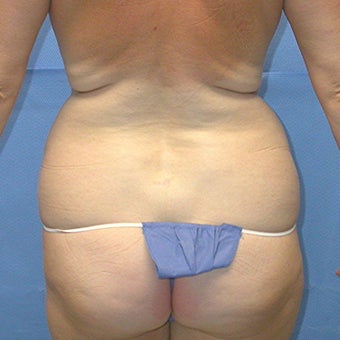 Liposuction of trunk. before 648145