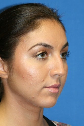 Rhinoplasty before 223234