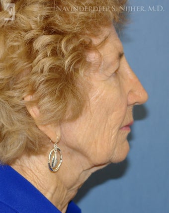 Facelift, Brow Lift & Eyelid Surgery before 502431