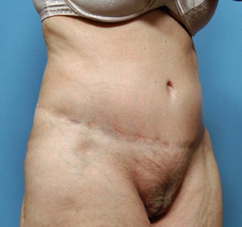 Tummy Tuck after 264553
