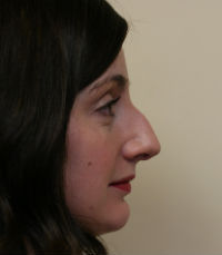 Rhinoplasty (nose reshaping) before 272586