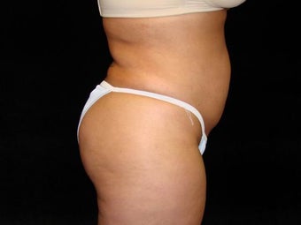 Liposuction of Abdomen, Waist, Flanks and Dorsal Roll after 203474