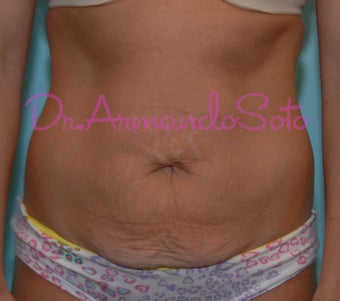 Abdominoplasty (Tummy Tuck) before 225070