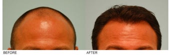 Hair Transplant before 141975