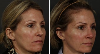 Revision Rhinoplasty and Sculptra before 314259