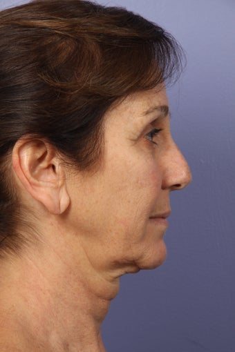 53 yr old Face and Necklift 622095