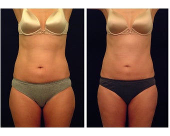 Liposuction before 397030