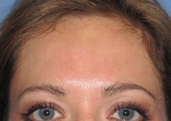 Chemical Peel ~ Vitalize after 166178