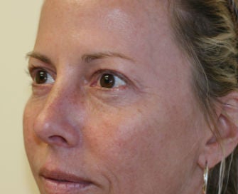 Upper and Lower Eyelids before 269094