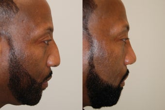 African-American Rhinoplasty: Profile view before 128282