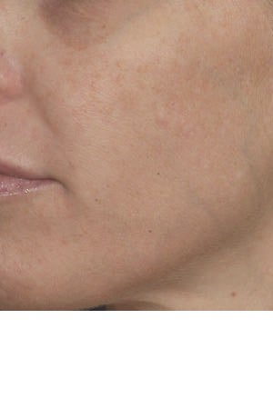 Alexandrite and IPL (Intense pulsed light) treatment after 119757