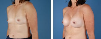 Breast Augmentation 349398