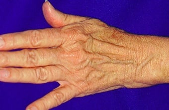 Sclerotherapy for hands before 371746