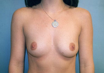 Breast Augmentation (425cc Saline Implants) after 238383