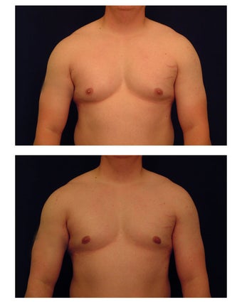 Gynecomastia (Male Breast Reduction) before 149368