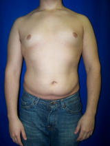Pec Implants before 130082