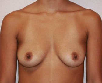 Augmentation Mammaplasty (Breast Implants) before 226506