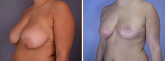Breast Reduction & Lift before 270050