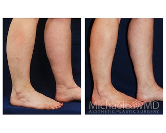Liposuction after 499133