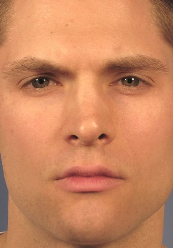 Revision Rhinoplasty before 410605