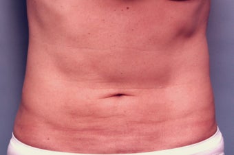 Slim Lipo after 137499
