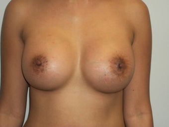 Breast Augmentation after 258582