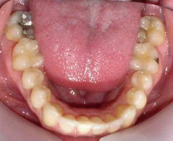 Invisalign after 146585