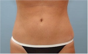SmartLiposuction after 601954