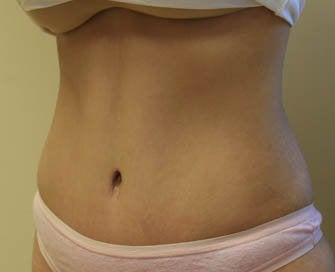 Abdominoplasty (Tummy Tuck) after 216665