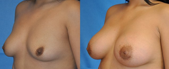 Flash Recovery Breast Augmentation (TM) before 256398