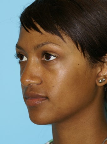 Nose Reshaping after 574628
