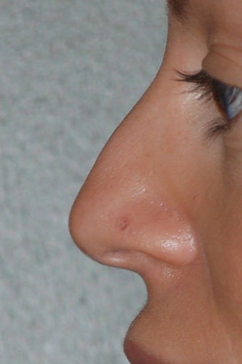 Rhinoplasty before 271669