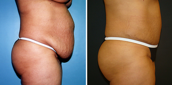 Tummy Tuck (Abdominoplasty) with Liposuction 262729