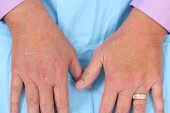 Radiesse for Hand Rejuvenation after 114166