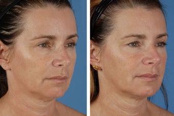 Radiesse & Botox Cosmetic after 356479